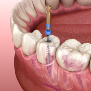 Root Canals at Dental Care Associates