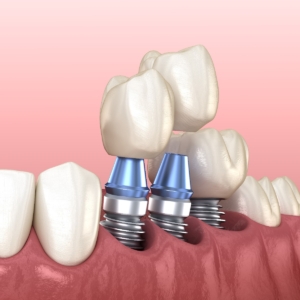 Dental Implants by Dental Care Associates