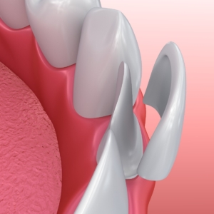 Dental Veneers by Dental Care Associates