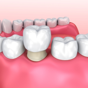 Dental Crowns with Dental Care Associates